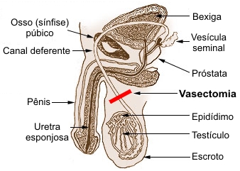 Vasectomía. «Hay muchísima desinformación»